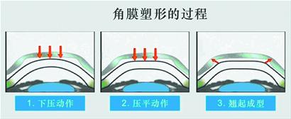 角膜塑形镜的角膜塑形过程